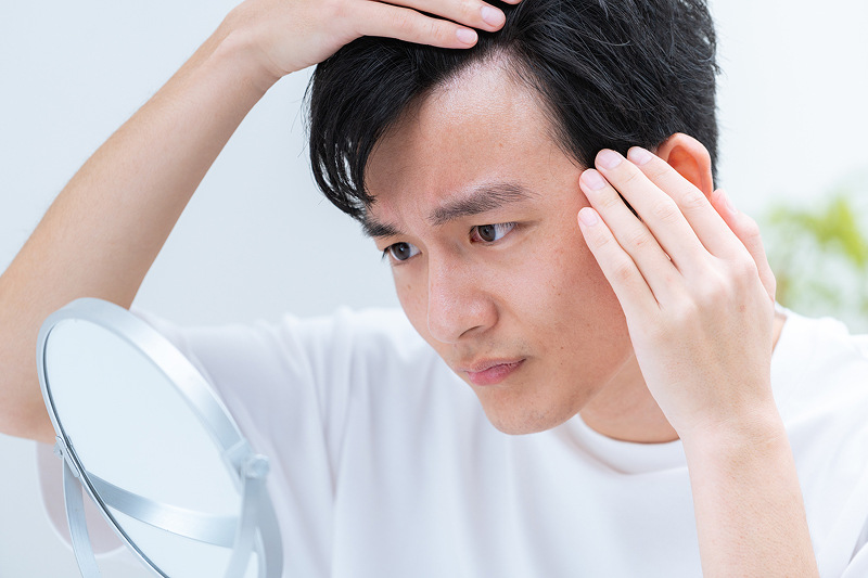 AGA（男性型脱毛症）とは